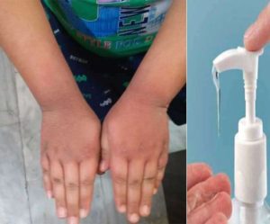 Sanitizer can cause infection, 13-year-old boy becomes victim of eczema in Amritsar